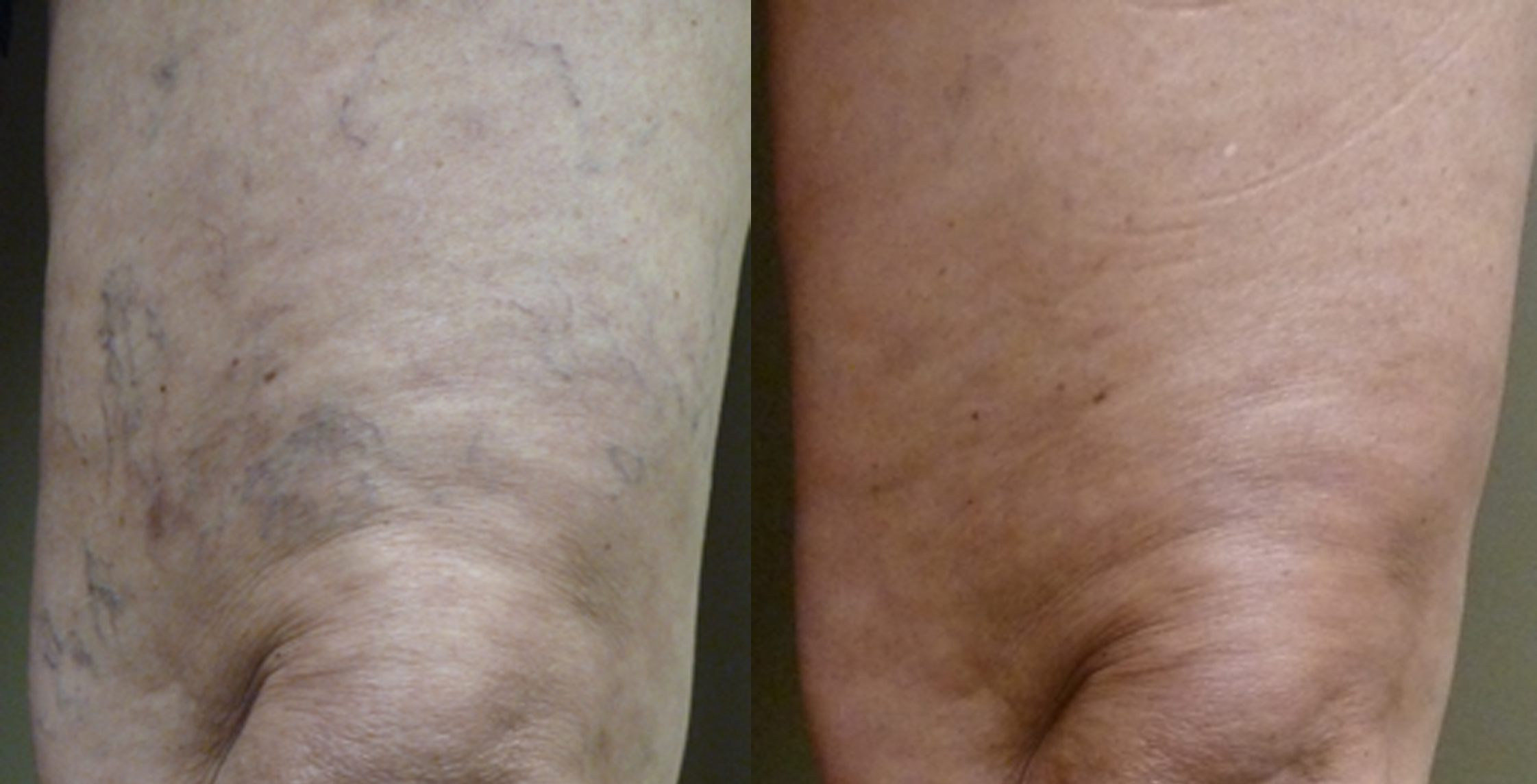 Vein Disease & Varicose Vein Treatment | Evansville, IN Owensboro, KY