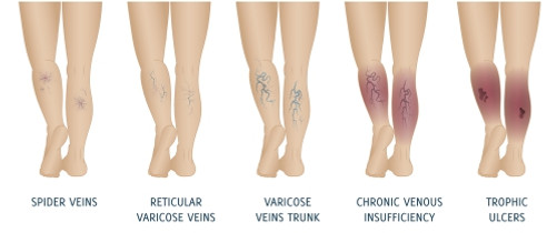 Spider-vein, Eravio Clinics, Dr. Neeraj R. Gechode
