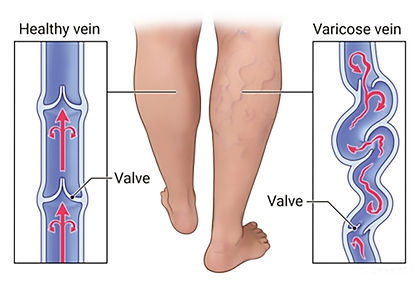 Endovenous-laser-ablation, Eravio Clinics, Dr. Neeraj R. Gechode