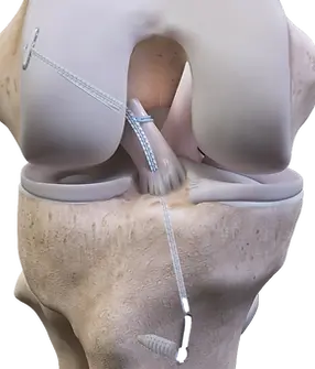 64dfddd9829fe440242b4e43_acl repair.webp