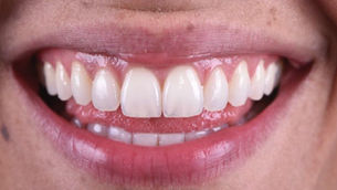 faccette-estetiche-dentali-prezzo