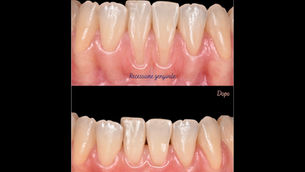 costo-innsesto-gengivale