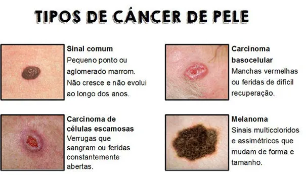Resultado de imagem para LesÃµes podem ser sinal de melanoma