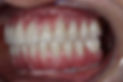 protocolo duplo protese total (2).jpeg