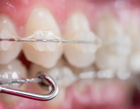 compressed_super-macro-shot-of-teeth-with-braces-2026-03-09-01-50-56-utc (1).webp