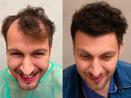 A before and after of a 4000 graft hair transplant procedure