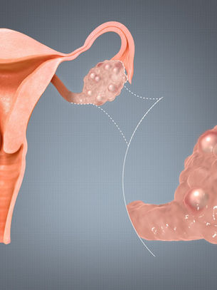 Když vaječníky nesou vinu za cizí hříchy: Proč PCOS ve skutečnosti vůbec není gynekologický problém