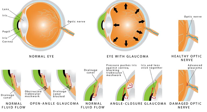 Types of Glaucoma