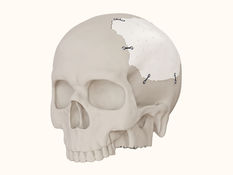 The Future of Skull Reconstruction: Patient-Specific 3D Printed Cranial Implants