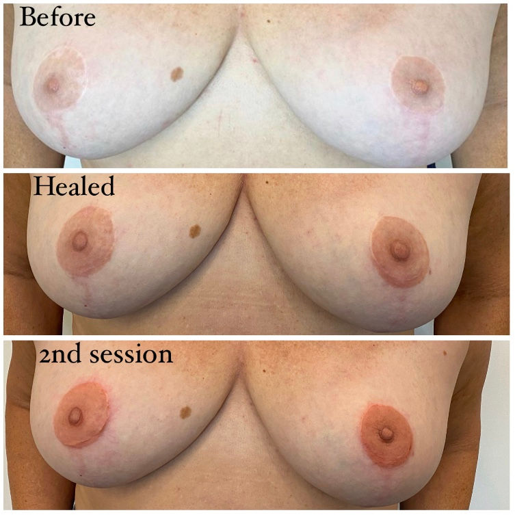 3D nipple tattoo designed to recreate depth and dimension on reconstructed skin