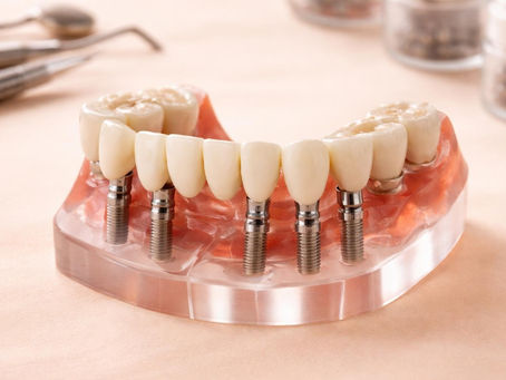 3 on 6 Dental Implants: Guia Completo 2026