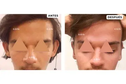 OTOPLASTIA