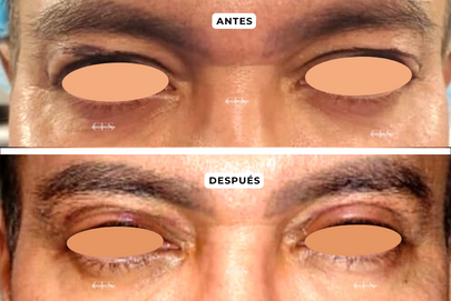 BLEFAROPLASTIA SUPERIOR