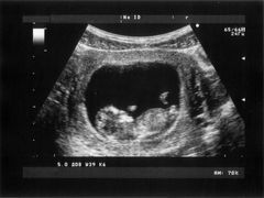 Bimbo nato senza gambe: il nodo è l'ecografia del quinto mese