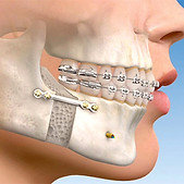 cirurgia-ortognatica (1).jpg
