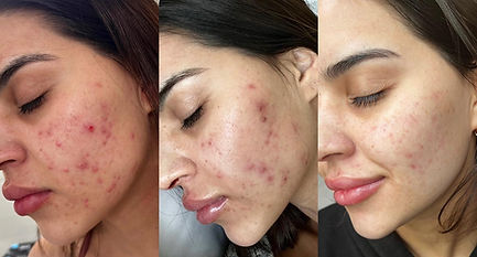 Chemical Peel Results