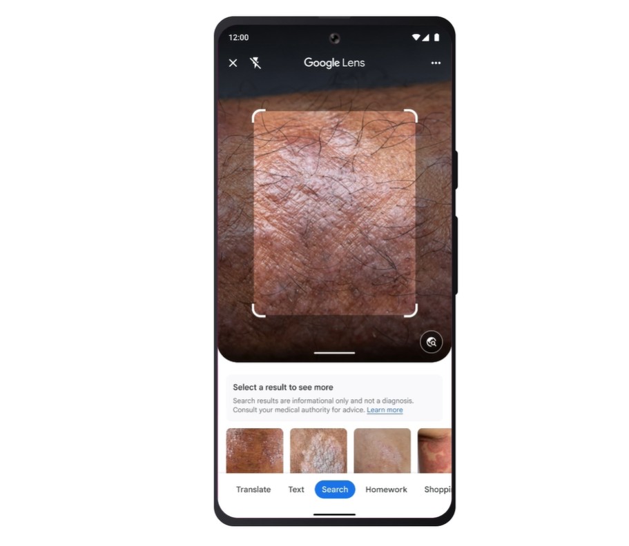 البحث عن حالة جلدية Google Lens