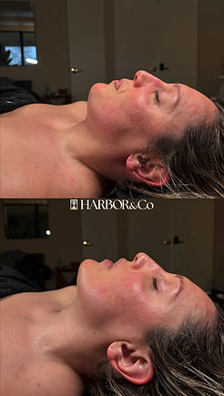 Before and after natural facial sculpting and anti-aging facial results.