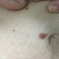 ελιές σώμα - έλεγχος