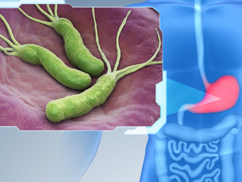 Viêm dạ dày do HP:  làm sao đây bác sĩ ơi ?