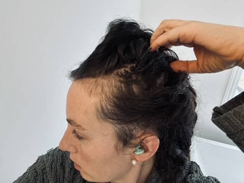 Close-up profile view of a woman with dark curly hair showing significant thinning and visible scalp at the crown. A hand parts the hair to reveal the extent of hair loss and shedding.