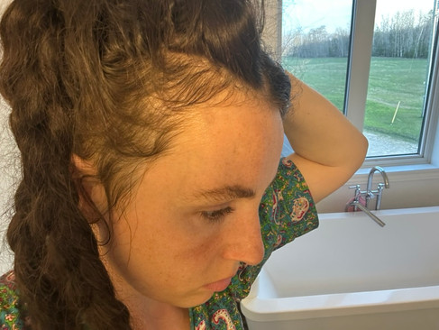 Side profile close-up of a woman with dark curly hair showing noticeable thinning and visible scalp along the part line at the crown. Her hand is raised to her head, highlighting the extent of hair shedding.
