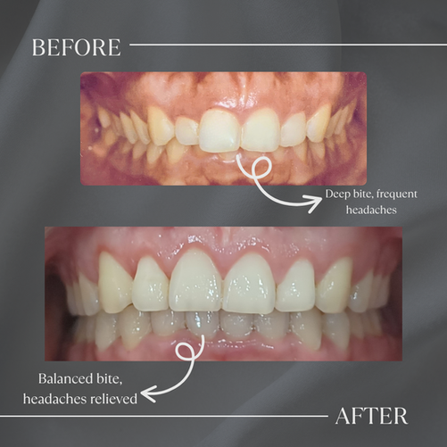 From TMJ Pain to Relief: How Bite Correction Stopped One Patient’s Headaches