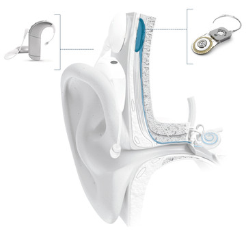 Cochlear-Implant-System-with-Ear-Anatomy