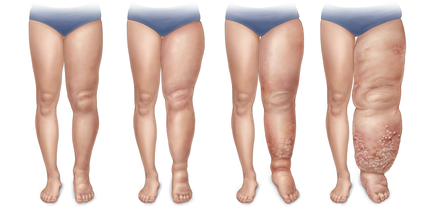 illu_med_stages-lymphedema-leg_sigvaris_group.webp