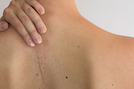 scar-treatments.jpg