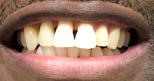 Aaron's Implants, Before and After