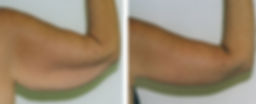 Lawton Urology Body Tite Arms_edited.jpg