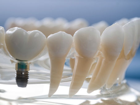 What to Expect After Dental Implant Surgery: A Comprehensive Recovery Guide