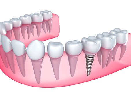 Can Same-Day Dental Implants Really Deliver? Here’s the Truth