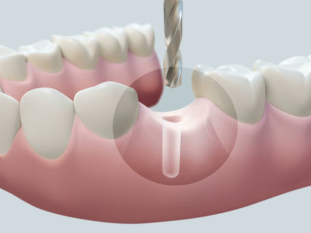 From Consultation to Confidence: Your Guide to Same-Day Dental Implants