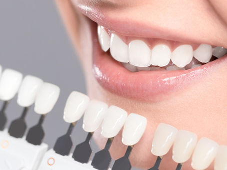 Everything You Should Know About the Dental Veneer Procedure