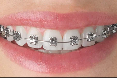 What to Expect During the First Few Weeks with Braces