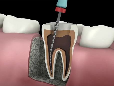 Root Canal Treatment in Dubai: What You Need to Know