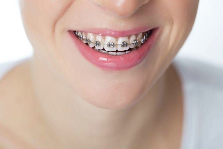 How Dental Braces Can Transform Your Smile and Confidence