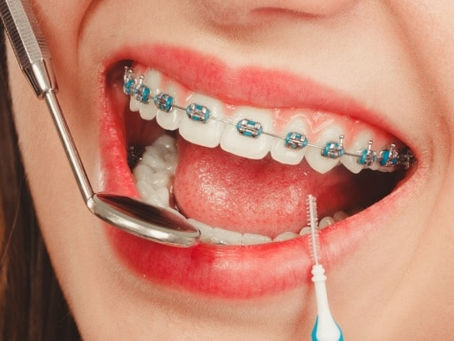 Dental Braces for Adults: Is It Too Late to Start?