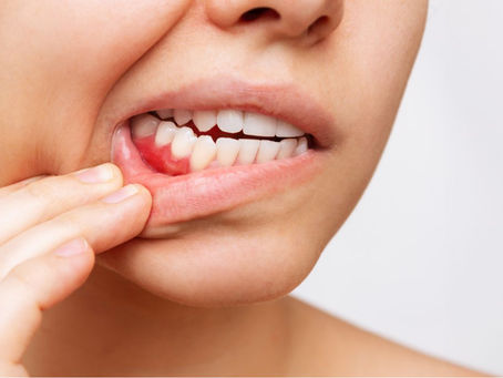 The Role of Gum Contouring in Achieving a Hollywood Smile