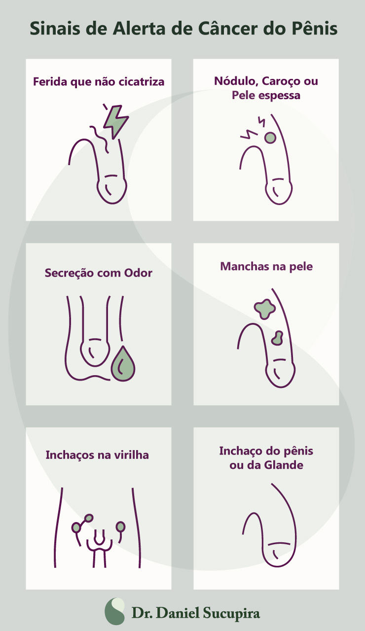 Infográfico educativo do Dr. Daniel Sucupira Urologista sobre Sinais de Alerta de Câncer do Pênis. O layout mostra seis quadros ilustrados com desenhos simples em linha roxa e detalhes em verde. Cada quadro representa um sintoma:  1 Ferida que não cicatriza (desenho de pênis com símbolo de dor). 2 Nódulo, caroço ou pele espessa (com bolha verde e linhas de dor).  3 Secreção com odor (gota verde saindo da uretra). 4 Manchas na pele (manchas verdes espalhadas pelo pênis).  5 Inchaços na virilha (linhas representando as pernas e gânglios aumentados).  6 Inchaço do pênis ou da glande (pênis com formato aumentado). Na parte inferior, o logotipo verde e o nome Dr. Daniel Sucupira.