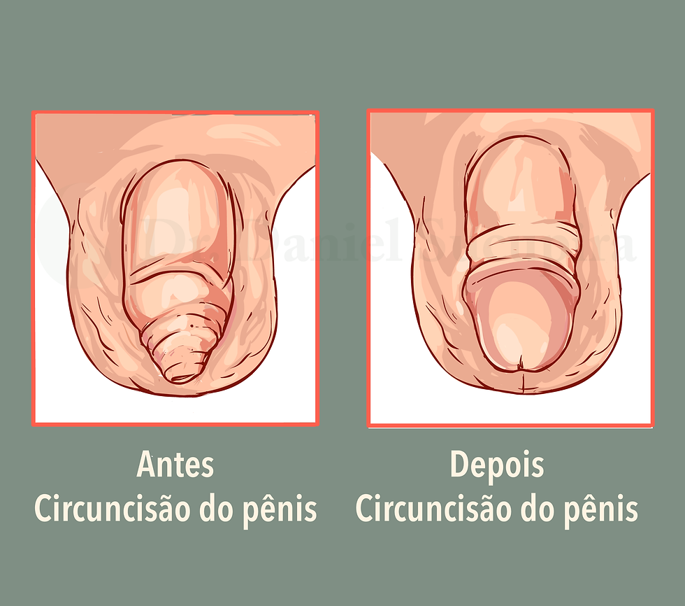 Ilustração médica comparando o pênis com fimose antes da cirurgia e o resultado após a circuncisão, com a glande exposta.