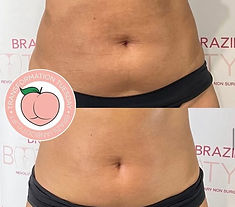 Non surgical tummy tuck