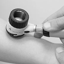 Eine der Hauptaufgaben des Hauarztes besteht in der

- Früherkennung von Hautkrebs in all seine Varianten
- Auflichtmikroskopie von Muttermalen
- Dokumentation von verdächtigen Läsionen bzw. raschen Zuführung zu einer Operation
- Hauttypberatung, Aufklärung, Sonnenexposition, Risikoprofil

Rund 2.000 Menschen erkranken jährlich in Österreich an einem Melanom, wobei rund 300 bis 400 Todesfälle pro Jahr zu verzeichnen sind. Auch die Zahl der Neuerkrankungen am weniger bekannten und daher häufig unterschätzten „weißen“ Hautkrebs („non-melanoma skin cancer“) steigt drastisch an, vor allem bei den 20- bis 30-Jährigen, was vermehrte Aufklärungsarbeit, verbunden mit regelmäßigen Vorsorgeuntersuchungen, notwendig macht. Nicht-Melanom-Hautkarzinome repräsentieren heute die häufigste Krebsform beim Menschen, mit jährlichen Zuwachsraten von 7–10%.
„Aktinische Keratosen sind nichts anderes als Plattenepithel-Karzinome ‚in situ,. In etwa 10% der Fälle entwickeln sich daraus invasive Plattenepithelkarzinome, die in die Tiefe wachsen.“
Ein ebenfalls sehr häufiger Hautkrebstyp ist das Basalzellkarzinom oder Basaliom, rund 20.000 bis 30.000 Neuerkrankungen sind jährlich in Österreich zu verzeichnen.


Die regelmäßige und vorbeugende Hautuntersuchung beim Facharzt kann Leben retten.
Mit Hilfe der Auflichtmikroskopie entscheidet der Hautarzt über Risikoläsionen und führt sie so rasch als möglich einer Operation zu.
Sollten im Einzelfall eine Fülle von Risikoläsionen vorhanden sein, besteht natürlich im Zeitalter der digitalen Auflichtmikroskopie die Möglichkeit der Dokumentation.
Die operativ entfernten Risikoläsionen werden einer histologischen Untersuchung (= Gewebsuntersuchung zugeführt) Bei der Ganzkörperuntersuchung besteht natürlich die Möglichkeit einer Hauttyp,- Risiko,- Sonnenschutzberatung mit dem Ziel den Aufenthalt im Freien und den Umgang mit der Sonne zu einem sorgenfreien Vergnügen zu machen.