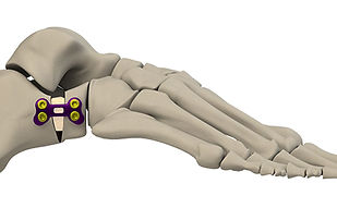 Bow & Arrow™ Evans Plate R3con Plating System™ 