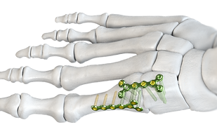 Baby Gorilla™ Y- Plates (Single and Double)