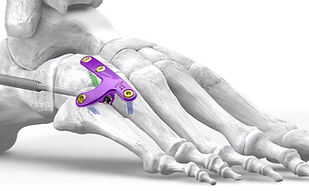 Lateral Column Plating System R3con Plating System™ 