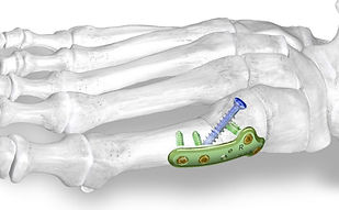 PROMO™ Tri-planar Hallux Valgus System