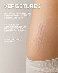 Atténuer, unifier, sublimer en douceur.
Une technique adaptée pour estomper visiblement les vergetures, en respectant votre peau.